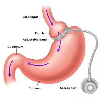 ADJUSTABLE GASTRIC BANDING